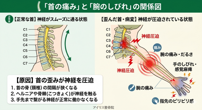 明石市 首の痛み 手のしびれ 原因を解説する図解。神経圧迫と症状の関係