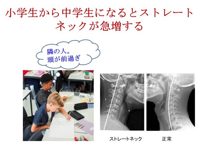 明石市 小中学生 ストレートネック の急増を解説する比較画像。勉強中の姿勢とレントゲン図解