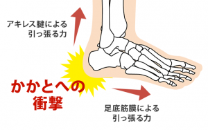 明石市 かかとの痛み を引き起こすシーバー病や足底筋膜炎のメカニズムを解説した骨格図